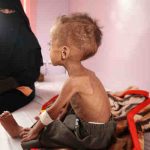 Over 2 Million Children in Yemen Are Malnourished: UNICEF