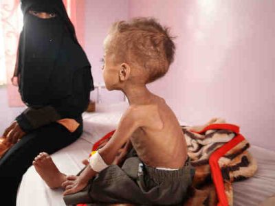 Over 2 Million Children in Yemen Are Malnourished: UNICEF